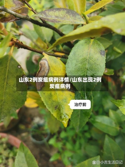 山东2例炭疽病例详情/山东出现2例炭疽病例