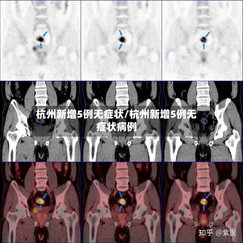 杭州新增5例无症状/杭州新增5例无症状病例-第3张图片