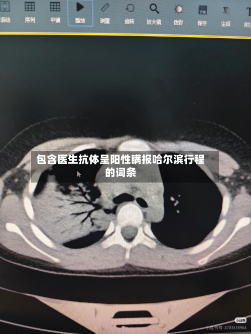 包含医生抗体呈阳性瞒报哈尔滨行程的词条-第3张图片